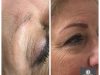 Boca Raton Microblading And Laser Hair removal